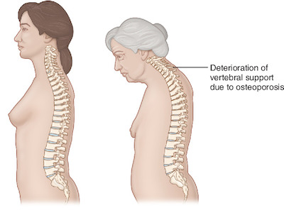 osteoporosi nella donna