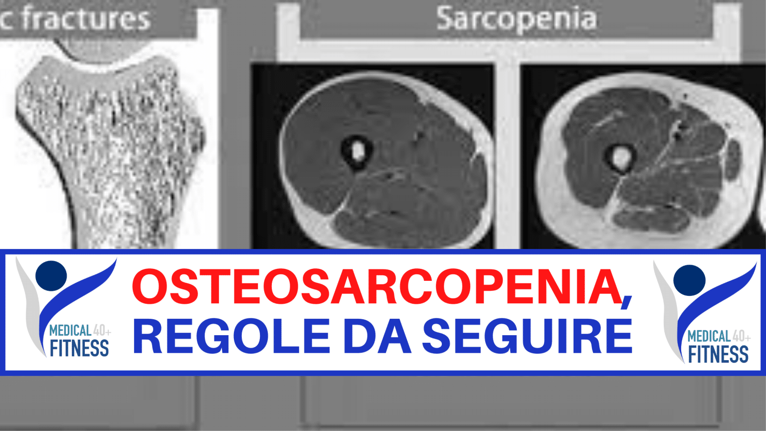 osteosarcopenia